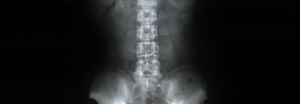 Spinal injuries are amongst the most common claims in Australian insurance fraud